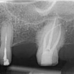 endodontie microscopica