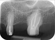 endodontie microscopica